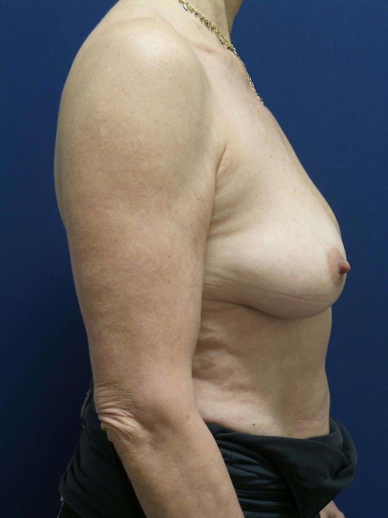 Breast Augmentation by Dr. Haydon Before & After Gallery - Patient 55455262 - Image 5