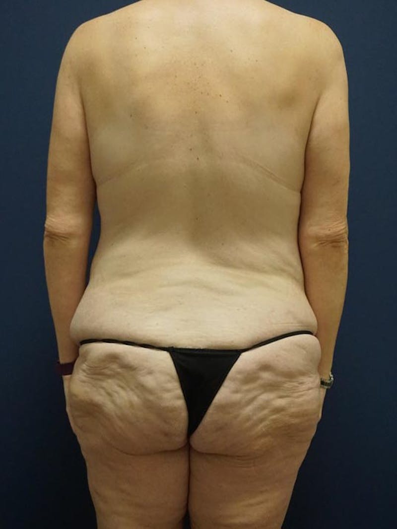 Liposuction by Dr. Haydon Before & After Gallery - Patient 55455264 - Image 5