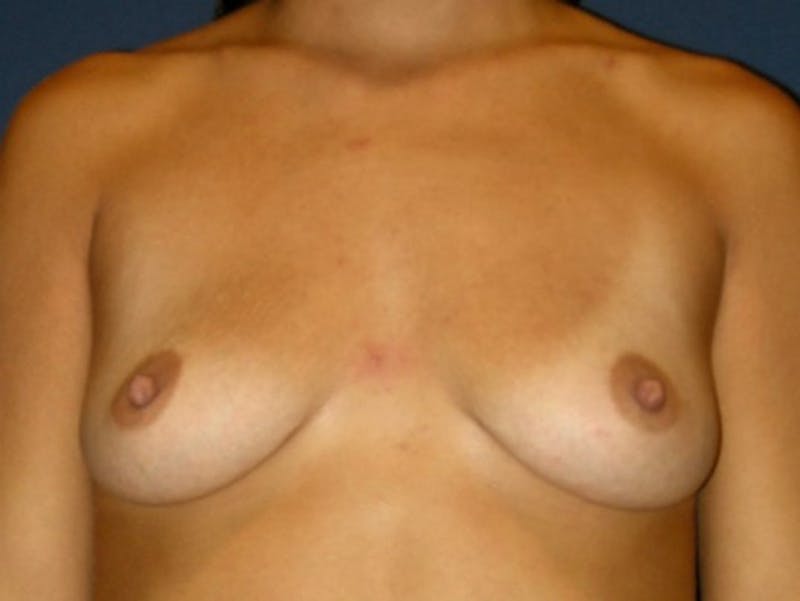 Breast Augmentation by Dr. Haydon Before & After Gallery - Patient 55455269 - Image 1