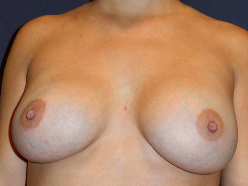 Breast Augmentation by Dr. Haydon Before & After Gallery - Patient 55455269 - Image 2