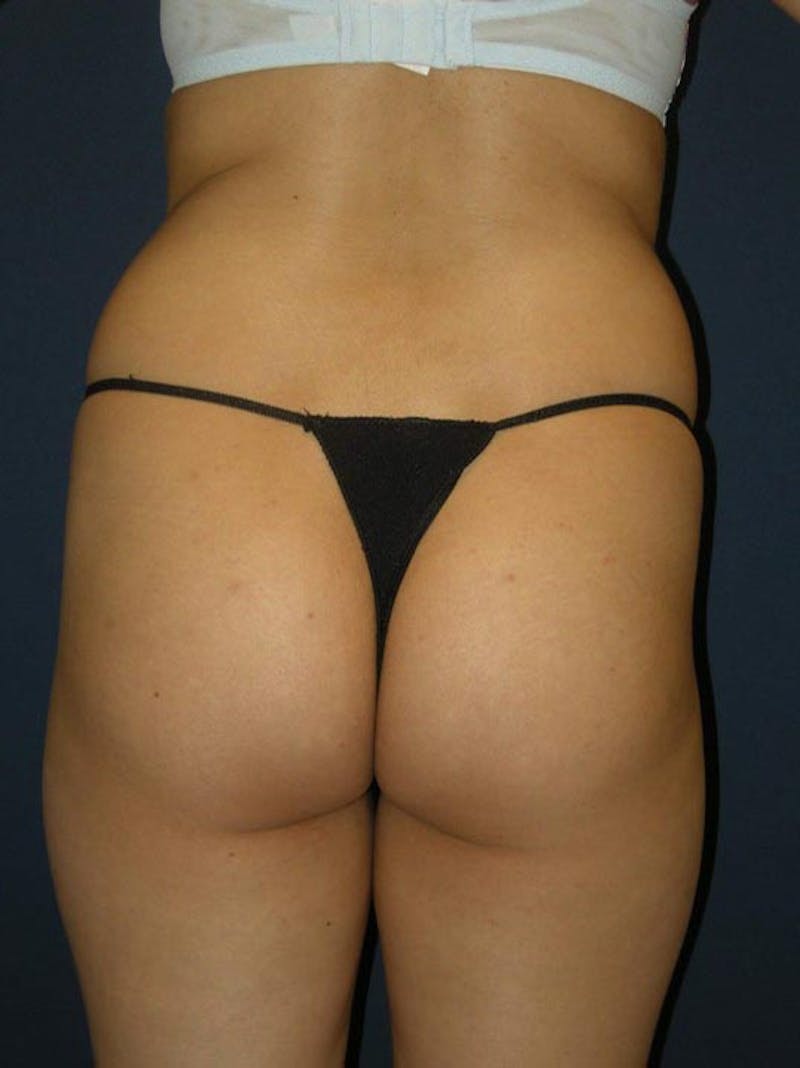 Liposuction by Dr. Haydon Before & After Gallery - Patient 55455268 - Image 1