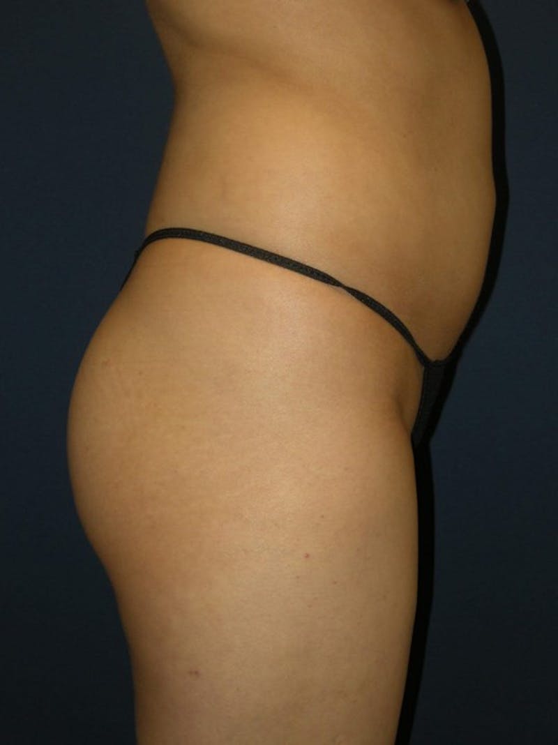 Liposuction by Dr. Haydon Before & After Gallery - Patient 55455268 - Image 3