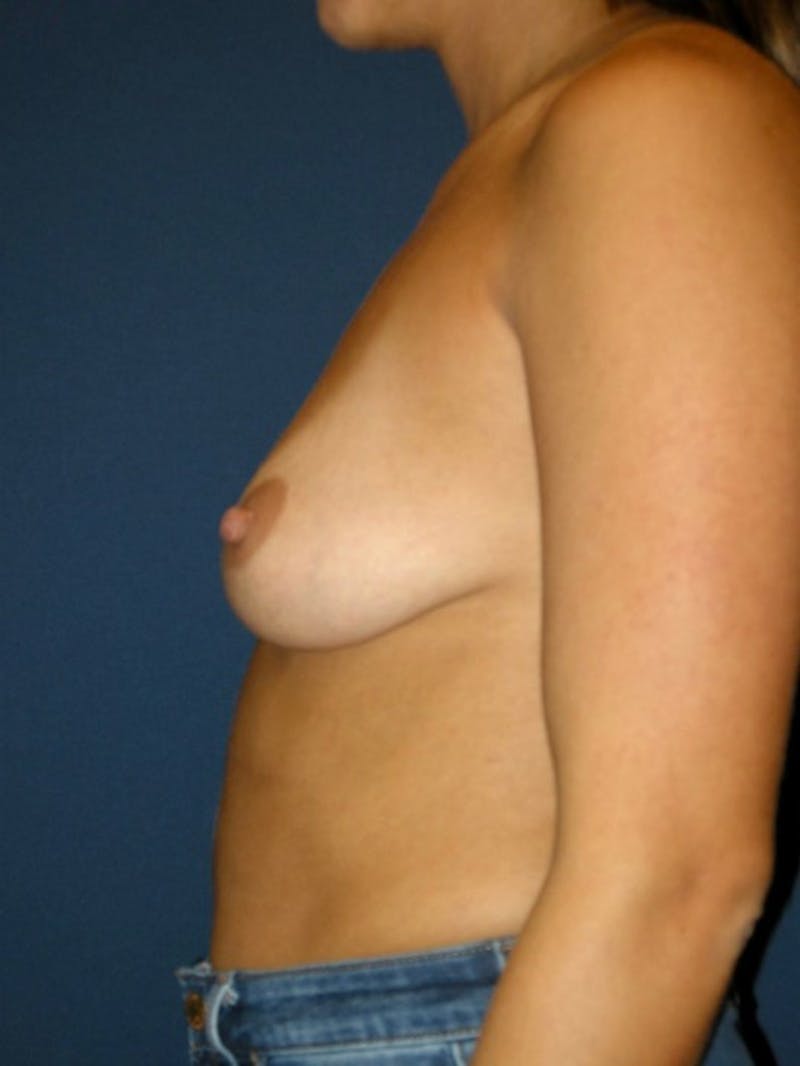 Breast Augmentation by Dr. Haydon Before & After Gallery - Patient 55455269 - Image 5