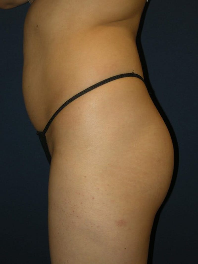 Liposuction by Dr. Haydon Before & After Gallery - Patient 55455268 - Image 5