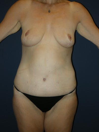 Tummy Tuck by Dr. Haydon Gallery - Patient 55455273 - Image 2