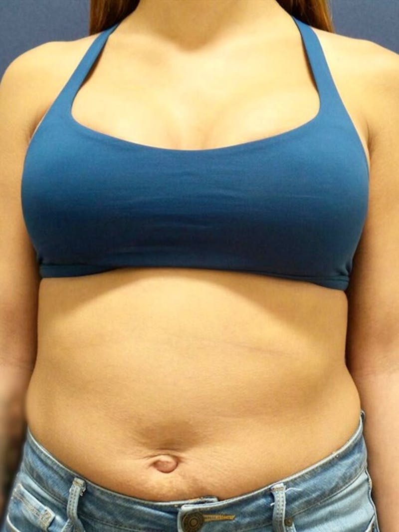 Breast Augmentation by Dr. Haydon Before & After Gallery - Patient 55455269 - Image 8
