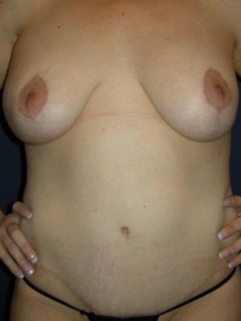 Breast Augmentation by Dr. Haydon Before & After Gallery - Patient 55455275 - Image 2