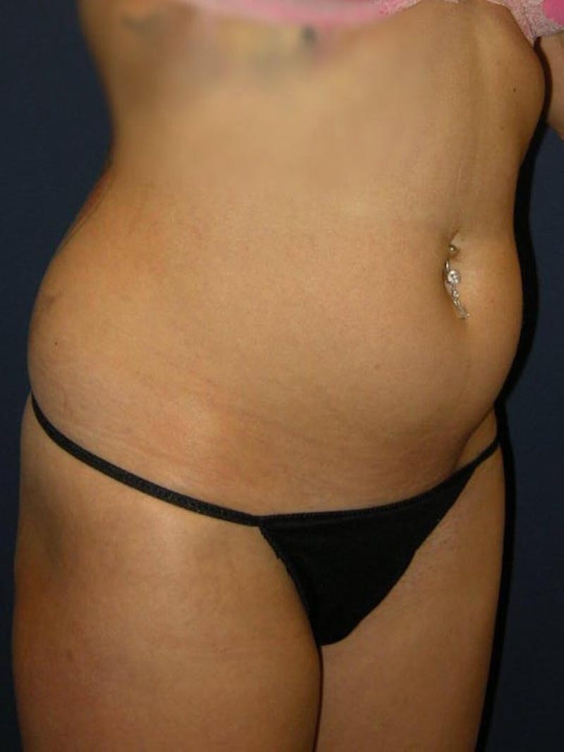 Liposuction by Dr. Haydon Gallery - Patient 55455278 - Image 3