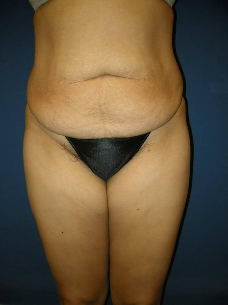 Tummy Tuck by Dr. Haydon Before & After Gallery - Patient 55455277 - Image 1