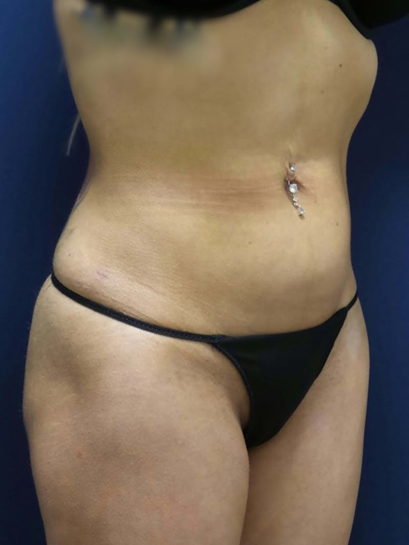 Liposuction by Dr. Haydon Before & After Gallery - Patient 55455278 - Image 4