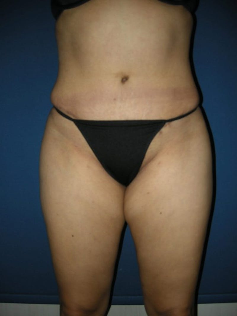 Tummy Tuck by Dr. Haydon Gallery - Patient 55455277 - Image 2
