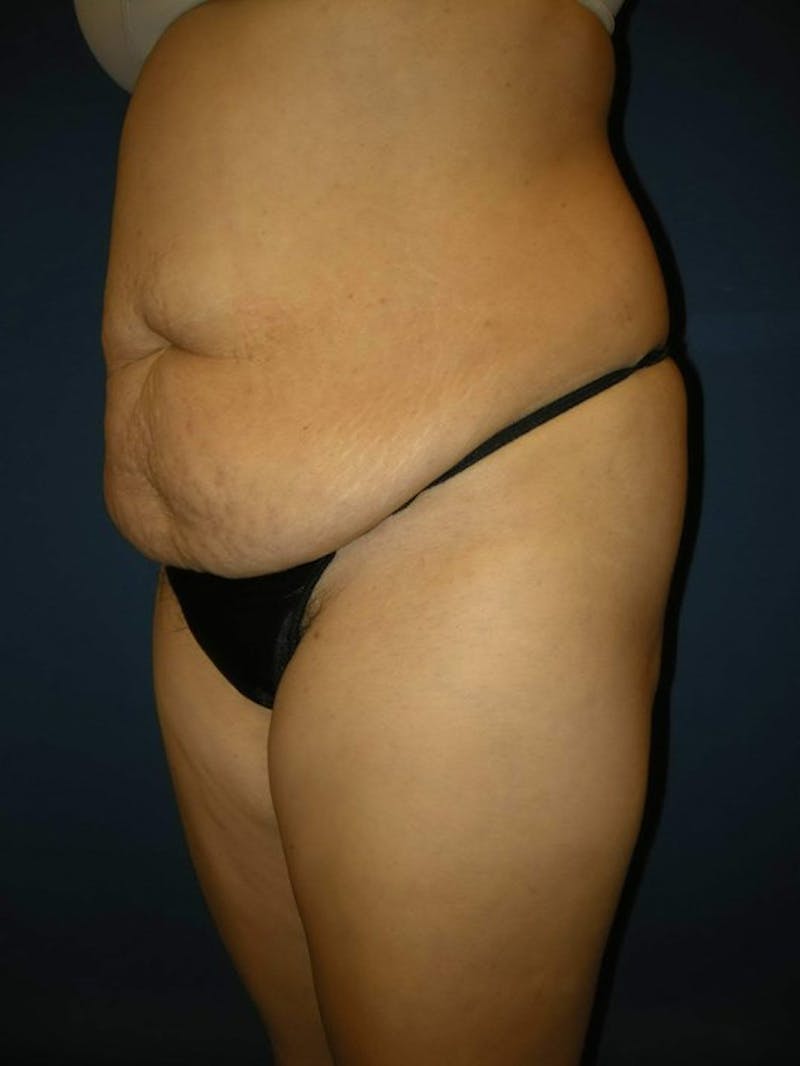 Tummy Tuck by Dr. Haydon Before & After Gallery - Patient 55455277 - Image 3