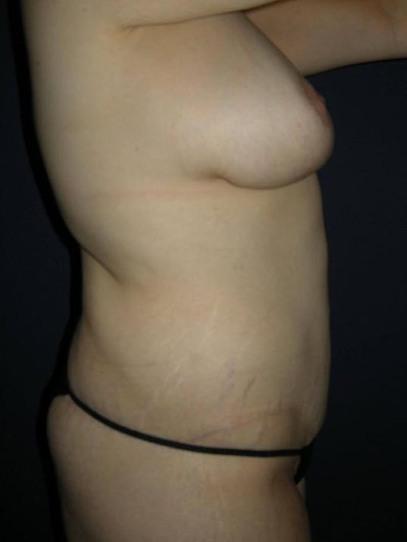 Breast Augmentation by Dr. Haydon Before & After Gallery - Patient 55455275 - Image 6