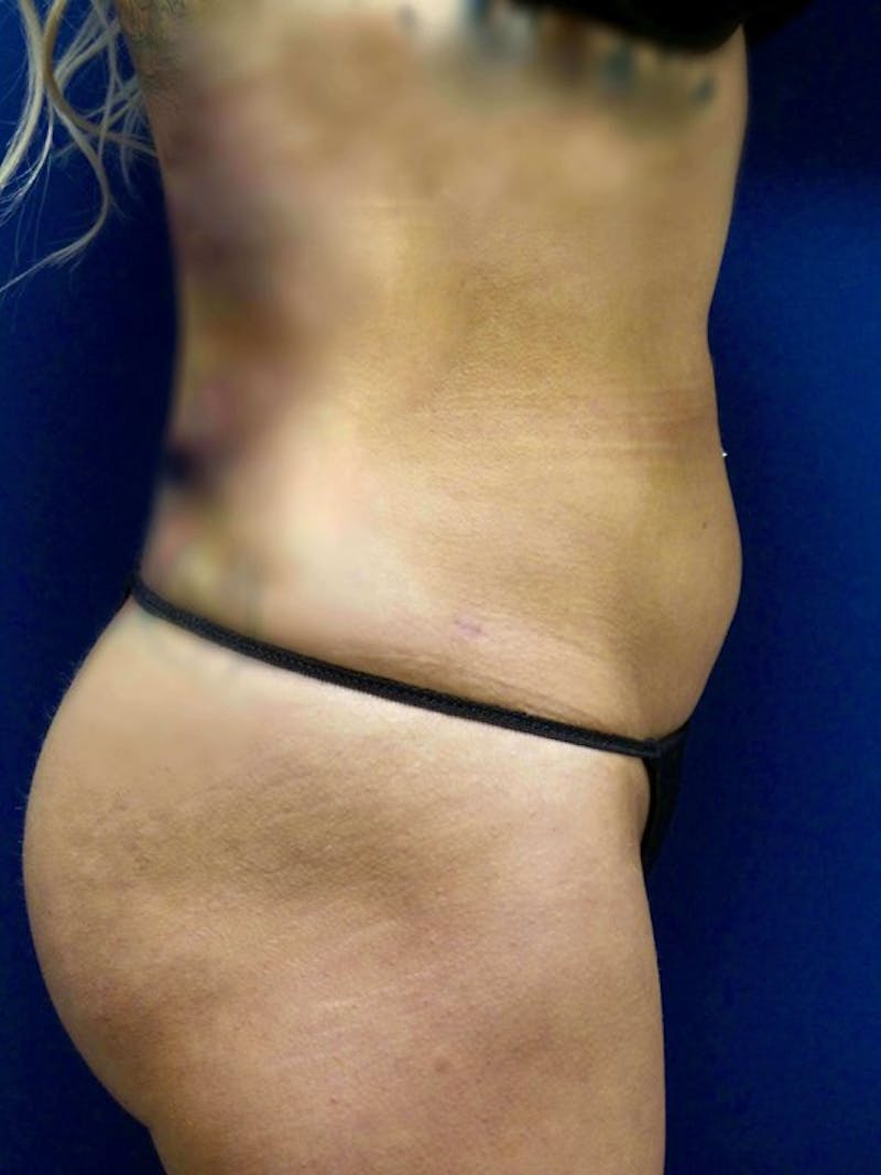 Liposuction by Dr. Haydon Before & After Gallery - Patient 55455278 - Image 6