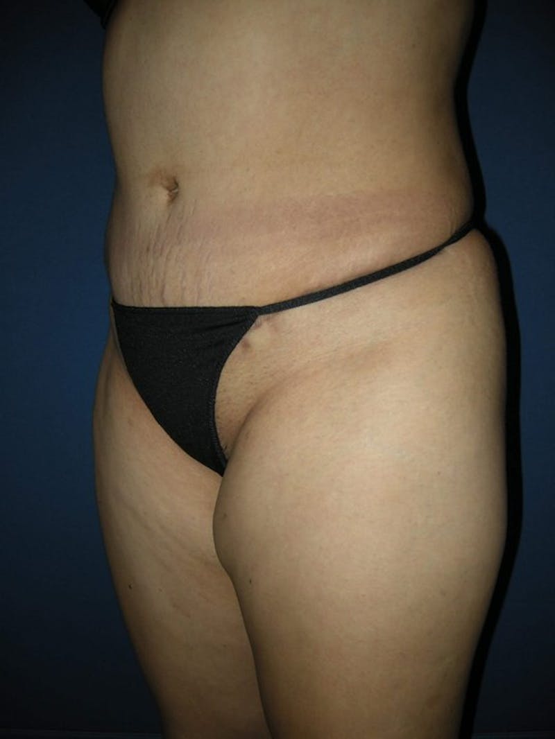 Tummy Tuck by Dr. Haydon Gallery - Patient 55455277 - Image 4