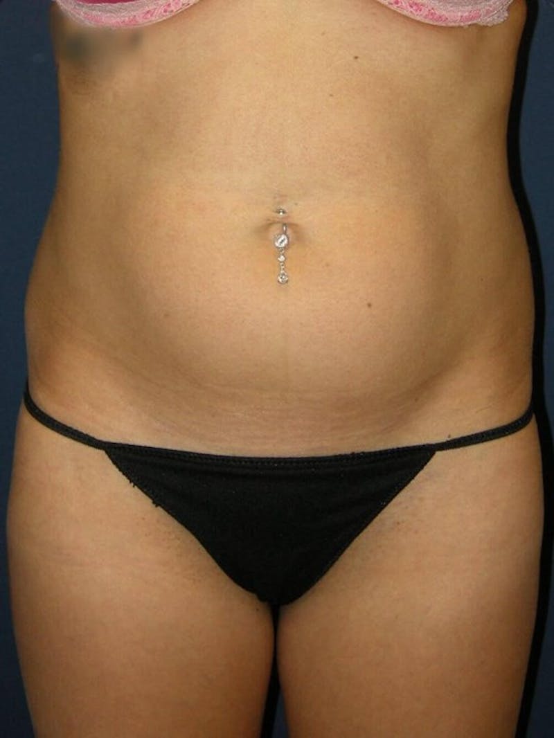 Liposuction by Dr. Haydon Before & After Gallery - Patient 55455278 - Image 7