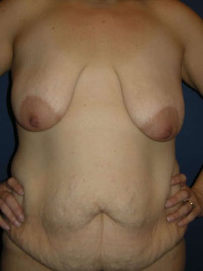 Mommy Makeover by Dr. Haydon Before & After Gallery - Patient 55455281 - Image 1