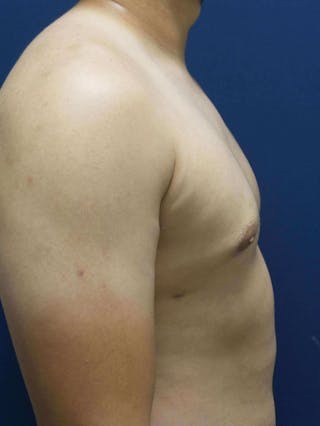 Liposuction by Dr. Haydon Before & After Gallery - Patient 55455282 - Image 6