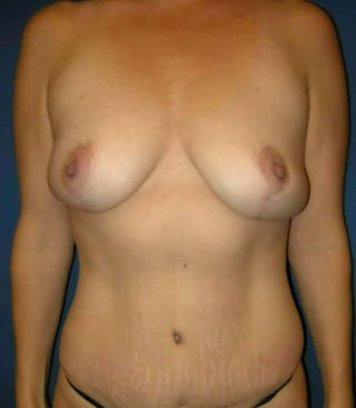 Mommy Makeover by Dr. Haydon Before & After Gallery - Patient 55455288 - Image 2