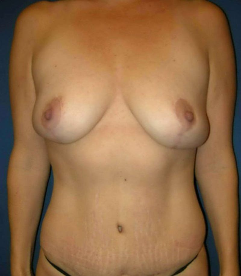 Tummy Tuck by Dr. Haydon Gallery - Patient 55455290 - Image 2