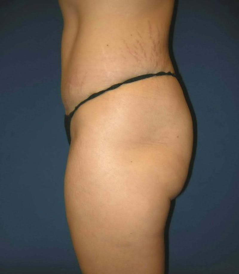 Tummy Tuck by Dr. Haydon Gallery - Patient 55455290 - Image 6