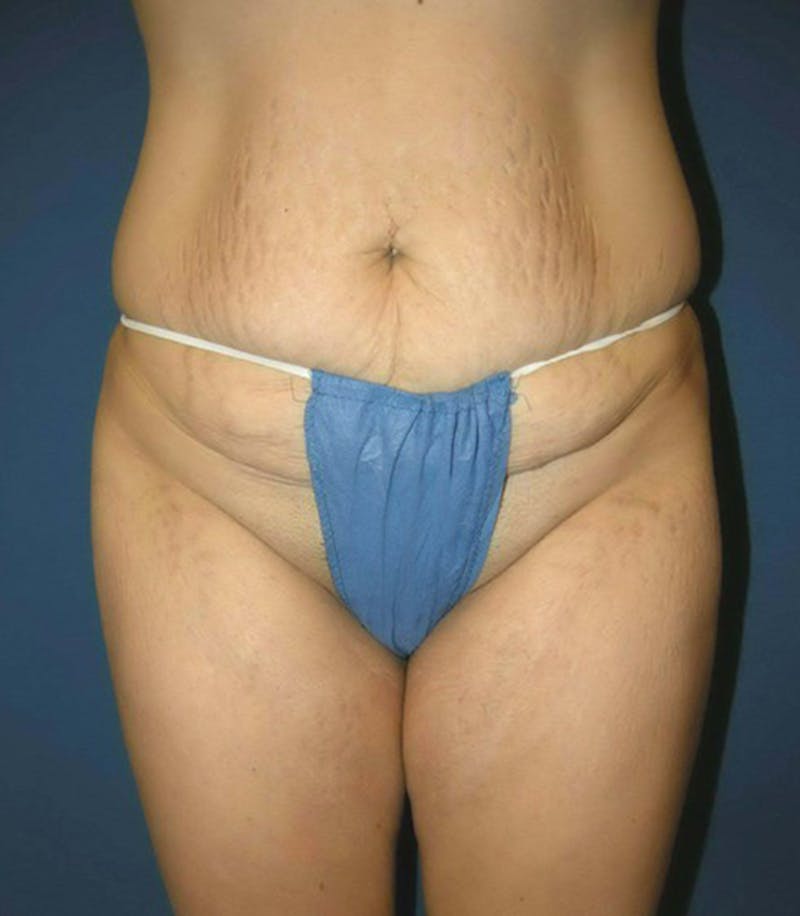 Liposuction by Dr. Haydon Gallery - Patient 55455293 - Image 3