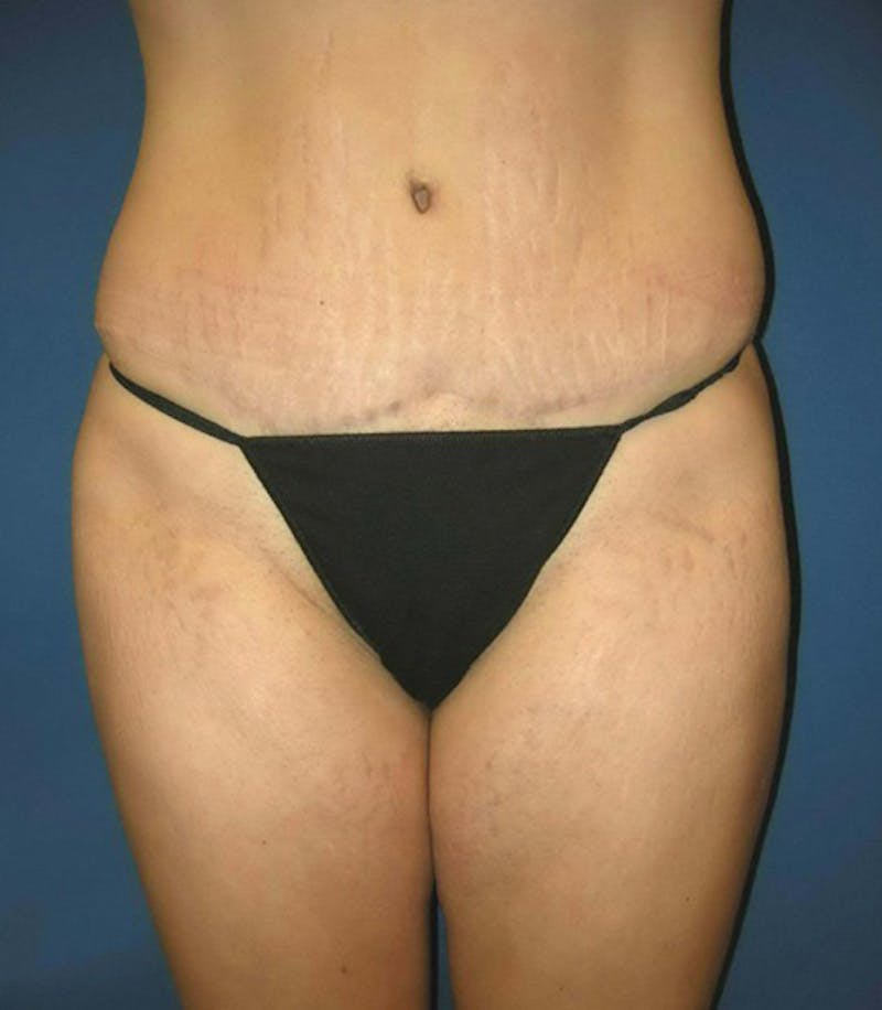 Liposuction by Dr. Haydon Before & After Gallery - Patient 55455293 - Image 4