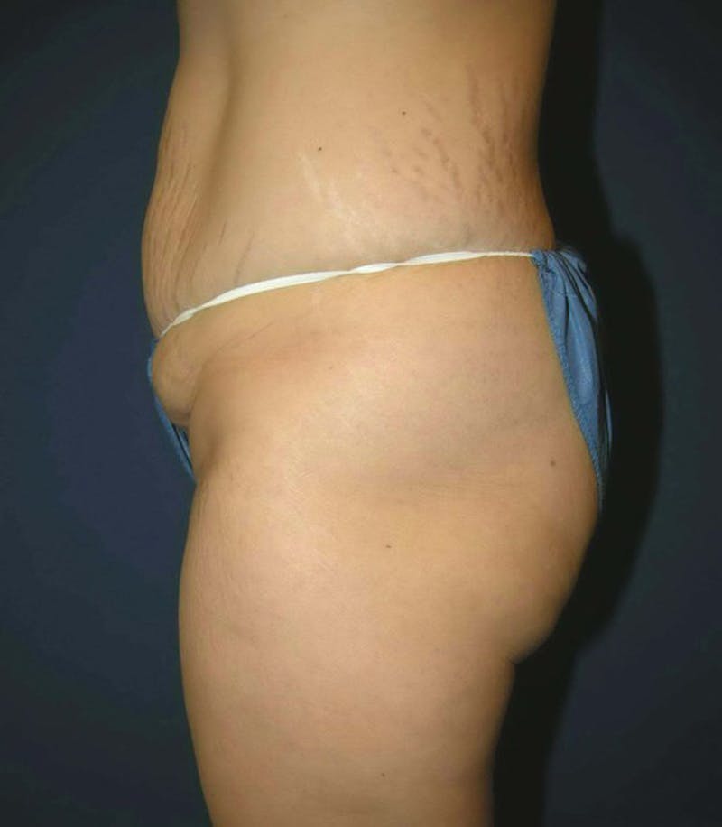 Liposuction by Dr. Haydon Before & After Gallery - Patient 55455293 - Image 5
