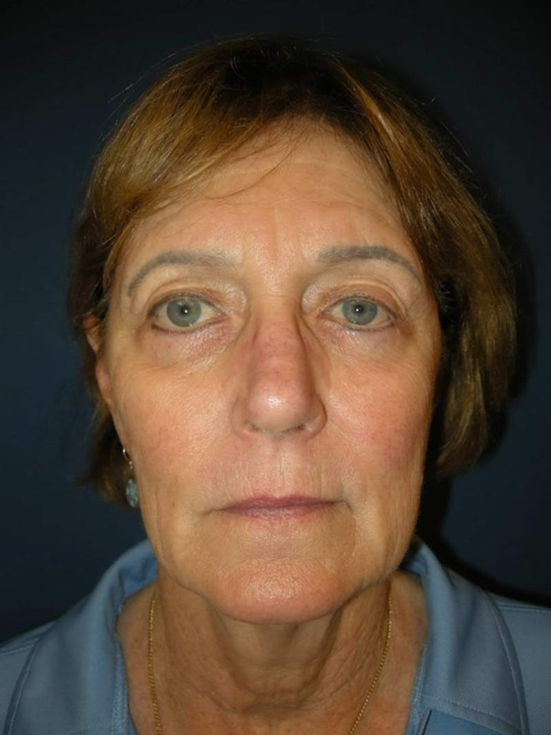 Neck Lift by Dr. Haydon Before & After Gallery - Patient 55455302 - Image 1