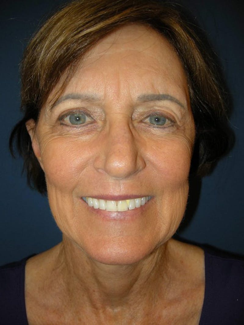 Neck Lift by Dr. Haydon Before & After Gallery - Patient 55455302 - Image 2