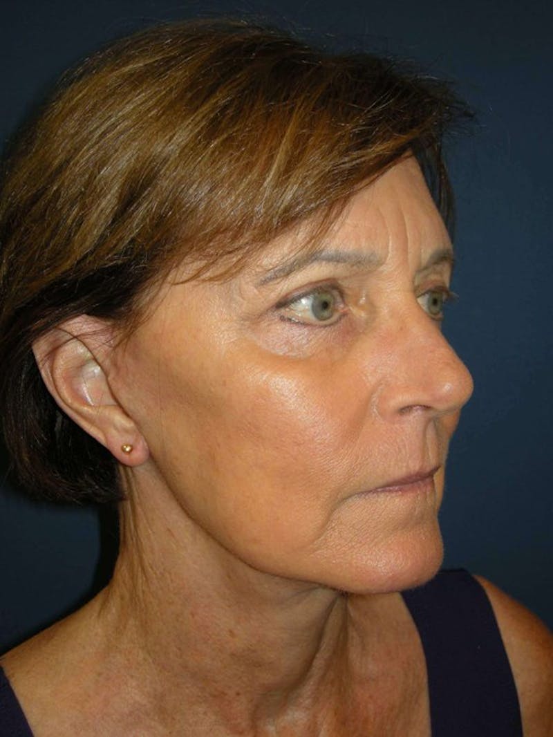 Neck Lift by Dr. Haydon Before & After Gallery - Patient 55455302 - Image 4