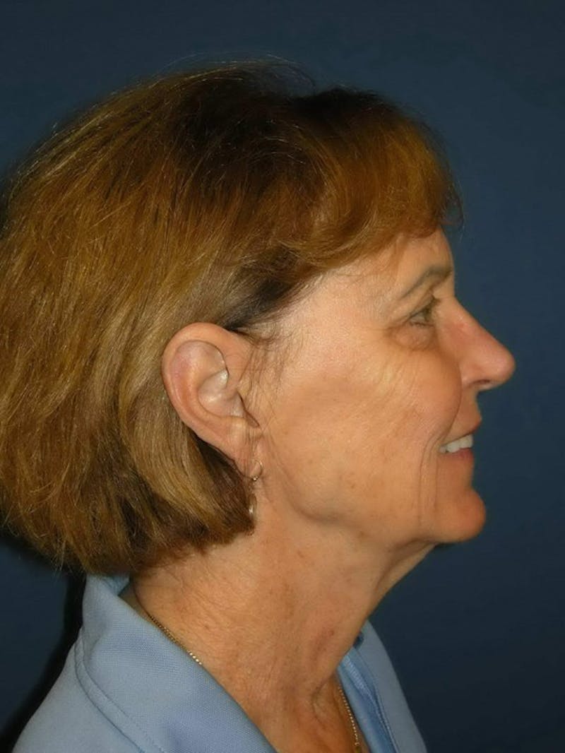 Neck Lift by Dr. Haydon Before & After Gallery - Patient 55455302 - Image 5