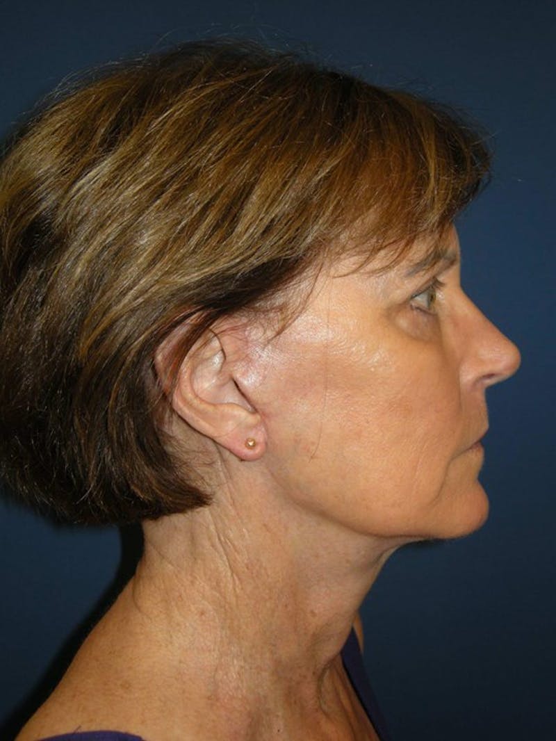 Neck Lift by Dr. Haydon Gallery - Patient 55455302 - Image 6