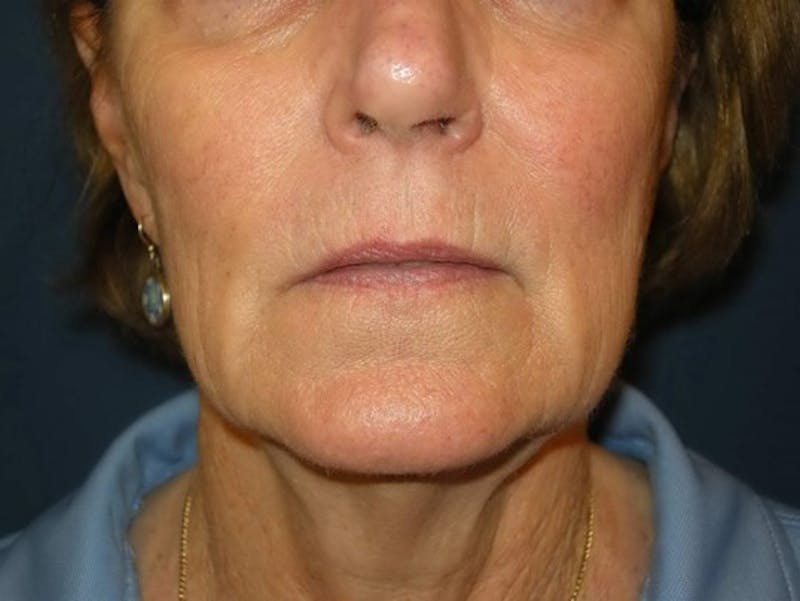 Neck Lift by Dr. Haydon Before & After Gallery - Patient 55455302 - Image 7
