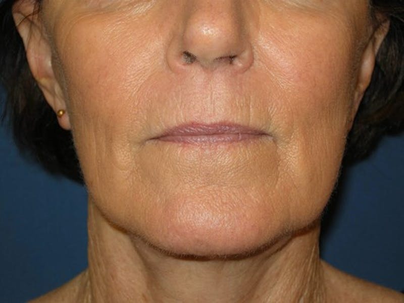 Neck Lift by Dr. Haydon Gallery - Patient 55455302 - Image 8