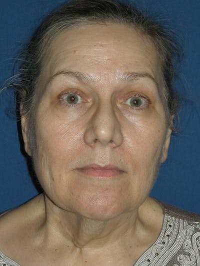 Neck Lift by Dr. Haydon Before & After Gallery - Patient 55455304 - Image 1