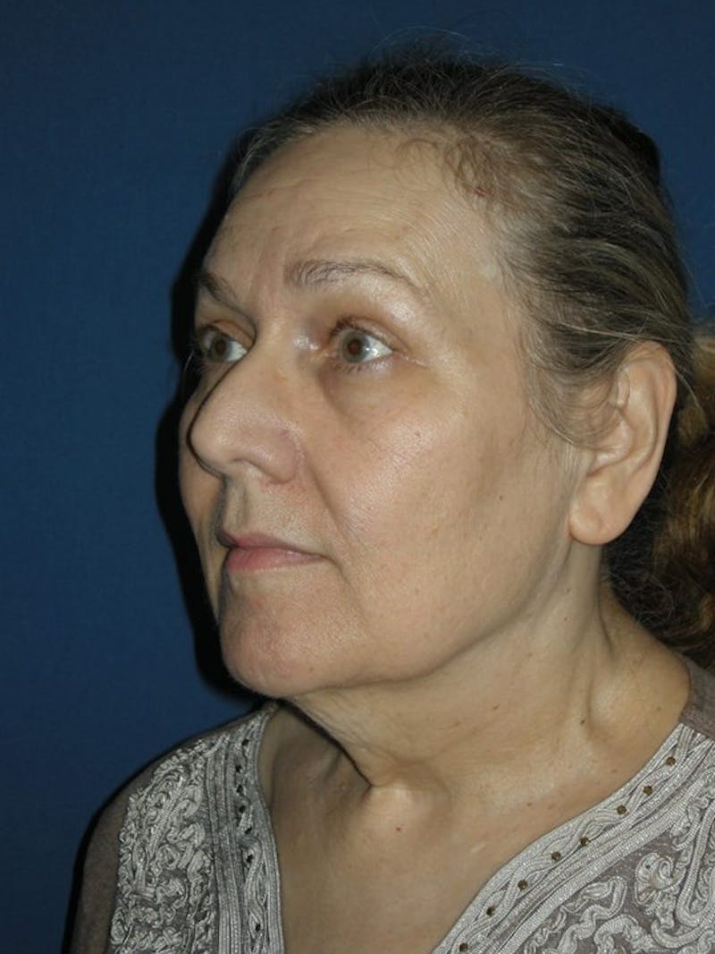 Neck Lift by Dr. Haydon Gallery - Patient 55455304 - Image 3
