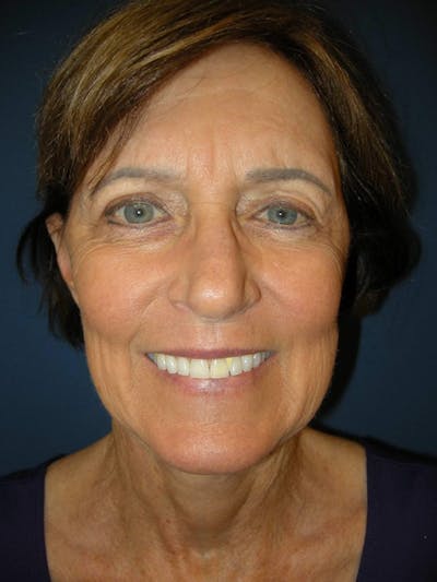 Facelift by Dr. Haydon Gallery - Patient 55455305 - Image 2