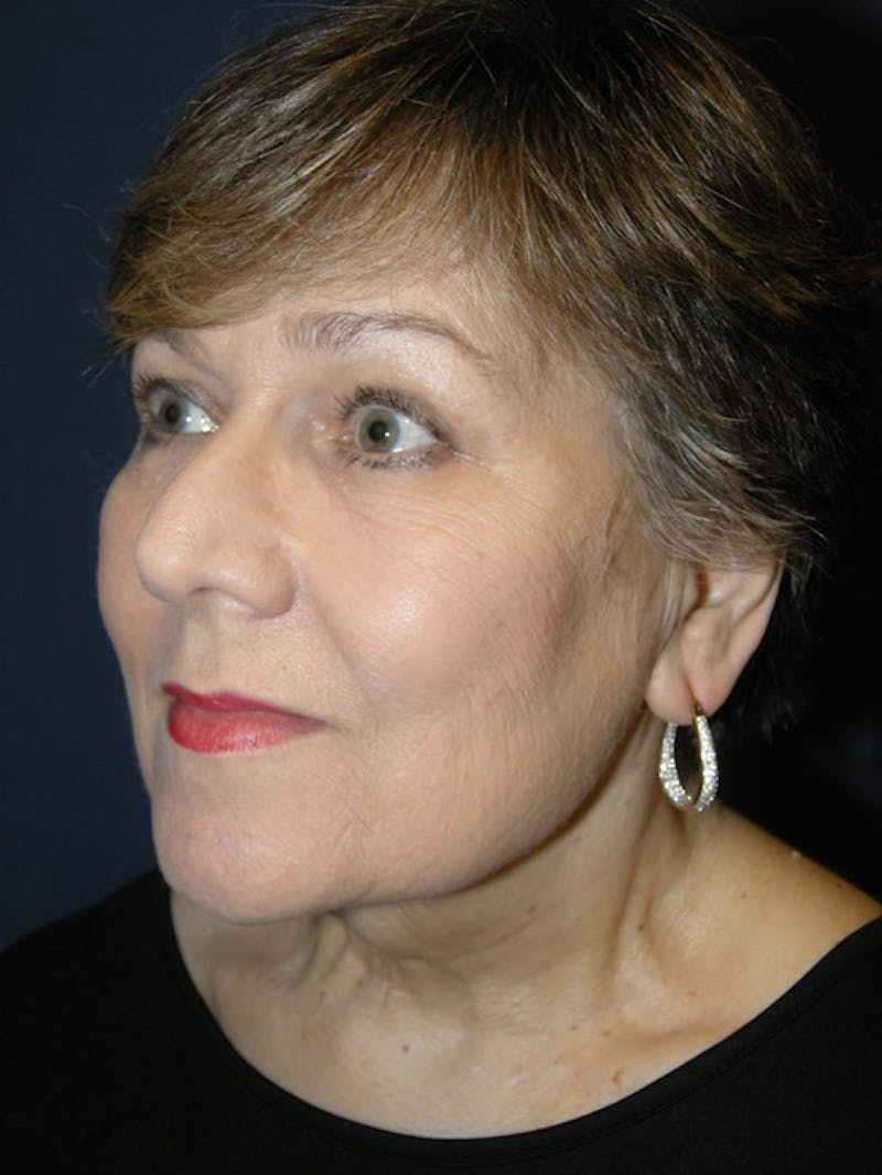 Neck Lift by Dr. Haydon Before & After Gallery - Patient 55455304 - Image 4