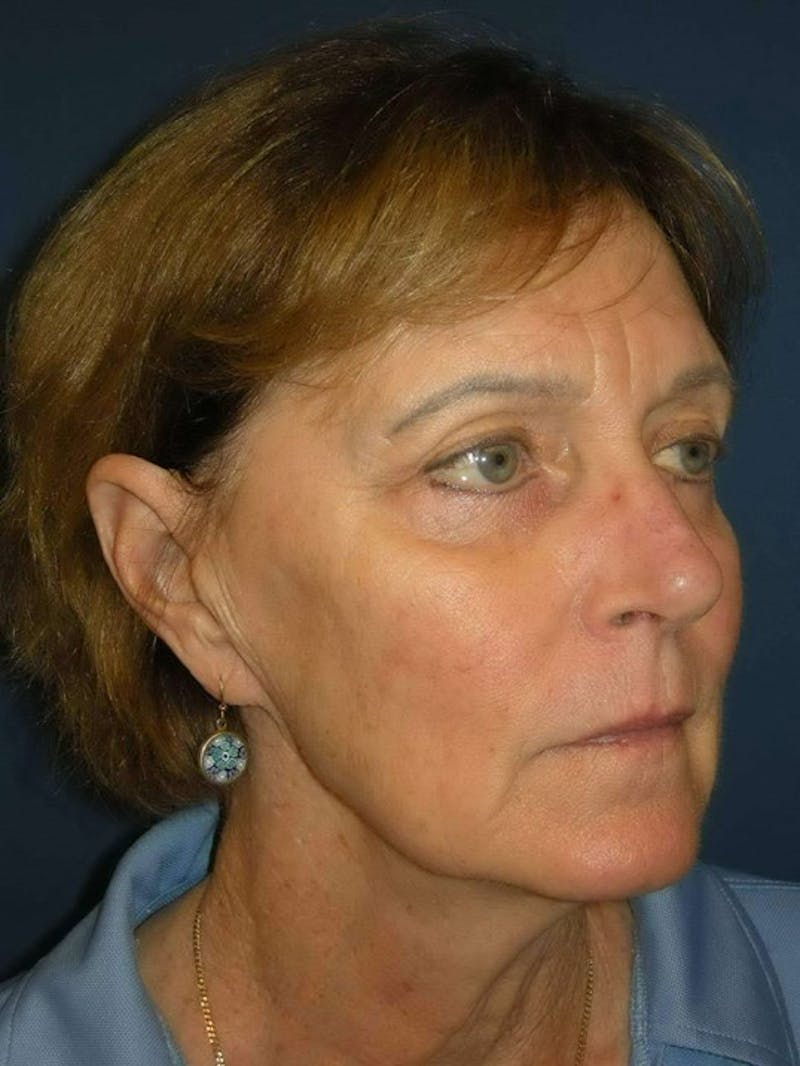 Facelift by Dr. Haydon Before & After Gallery - Patient 55455305 - Image 3