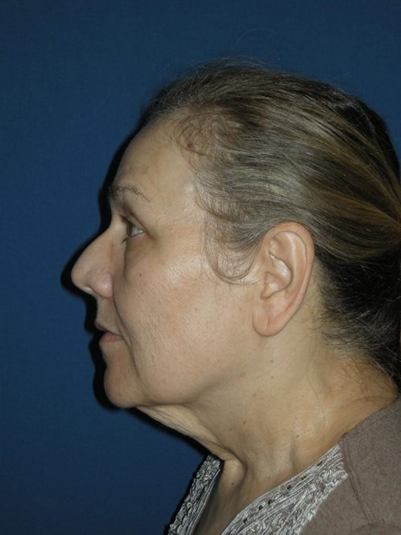 Neck Lift by Dr. Haydon Before & After Gallery - Patient 55455304 - Image 5