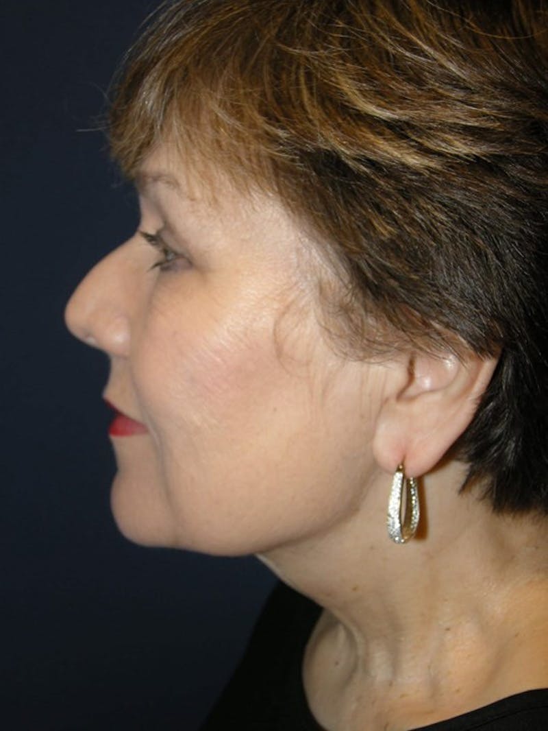 Neck Lift by Dr. Haydon Gallery - Patient 55455304 - Image 6