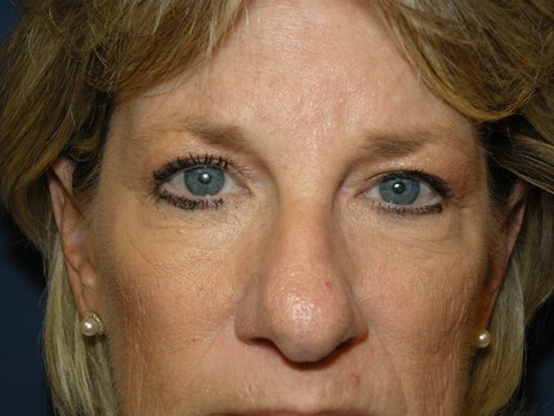 Facelift by Dr. Haydon Before & After Gallery - Patient 55455307 - Image 1