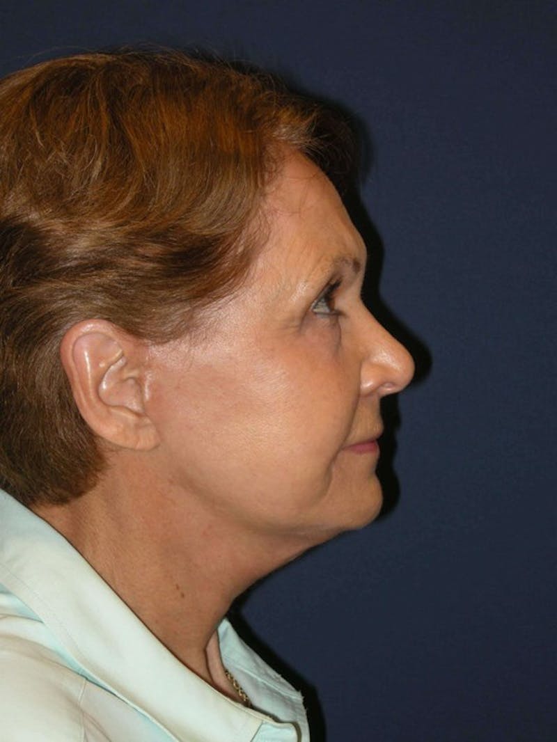 Neck Lift by Dr. Haydon Before & After Gallery - Patient 55455306 - Image 6