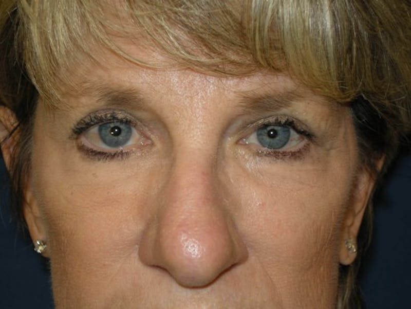 Facelift by Dr. Haydon Gallery - Patient 55455307 - Image 2