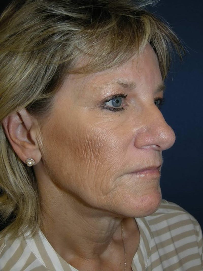 Facelift by Dr. Haydon Before & After Gallery - Patient 55455307 - Image 3