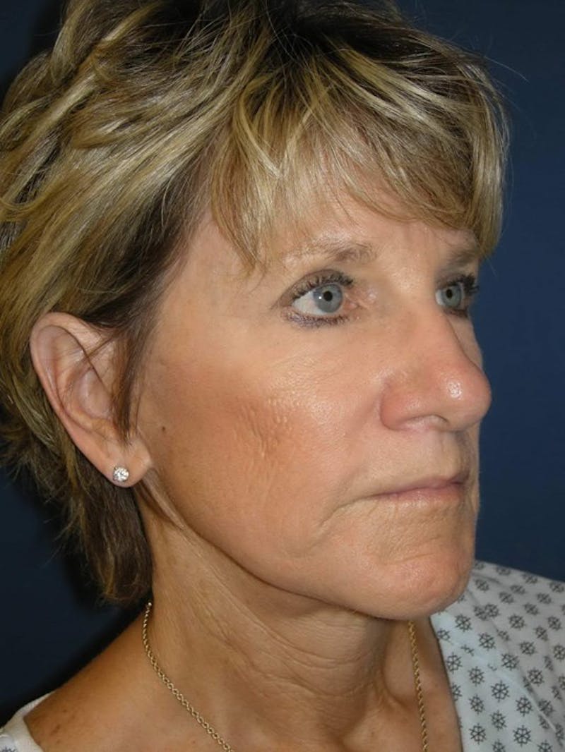 Facelift by Dr. Haydon Before & After Gallery - Patient 55455307 - Image 4