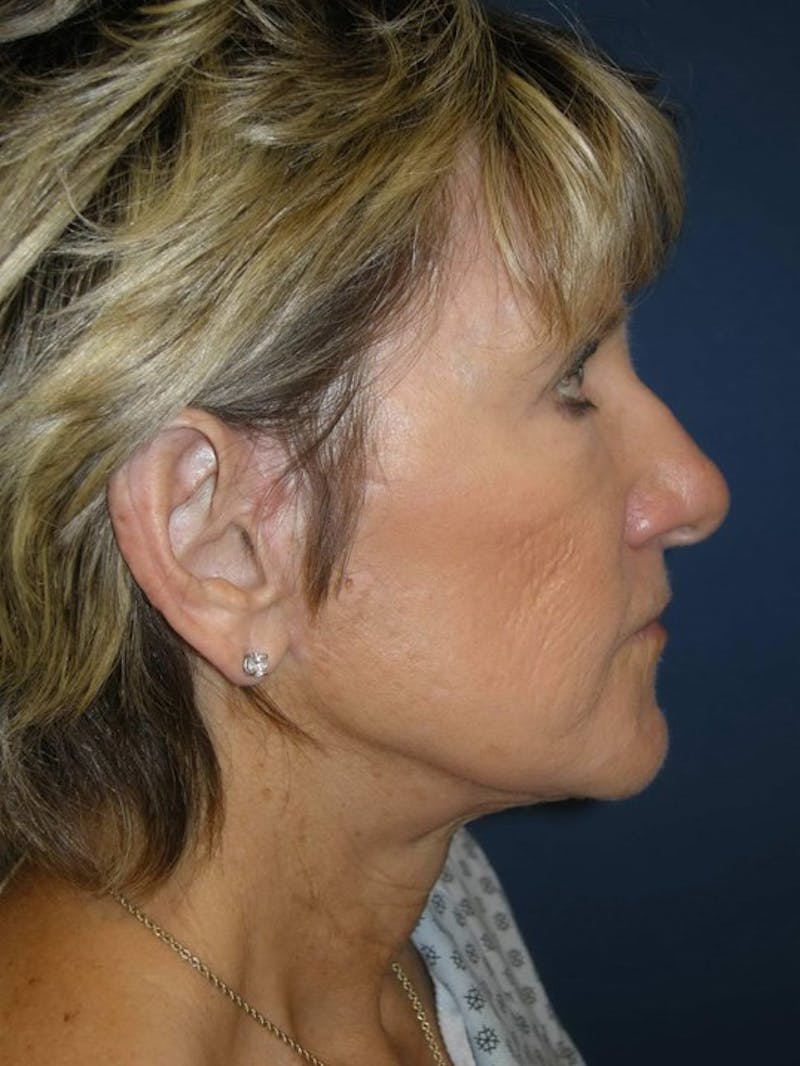 Facelift by Dr. Haydon Before & After Gallery - Patient 55455307 - Image 6