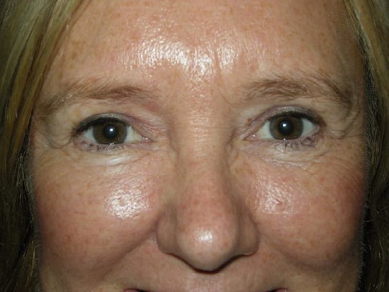 Eyelid Surgery by Dr. Haydon Before & After Gallery - Patient 55455309 - Image 2