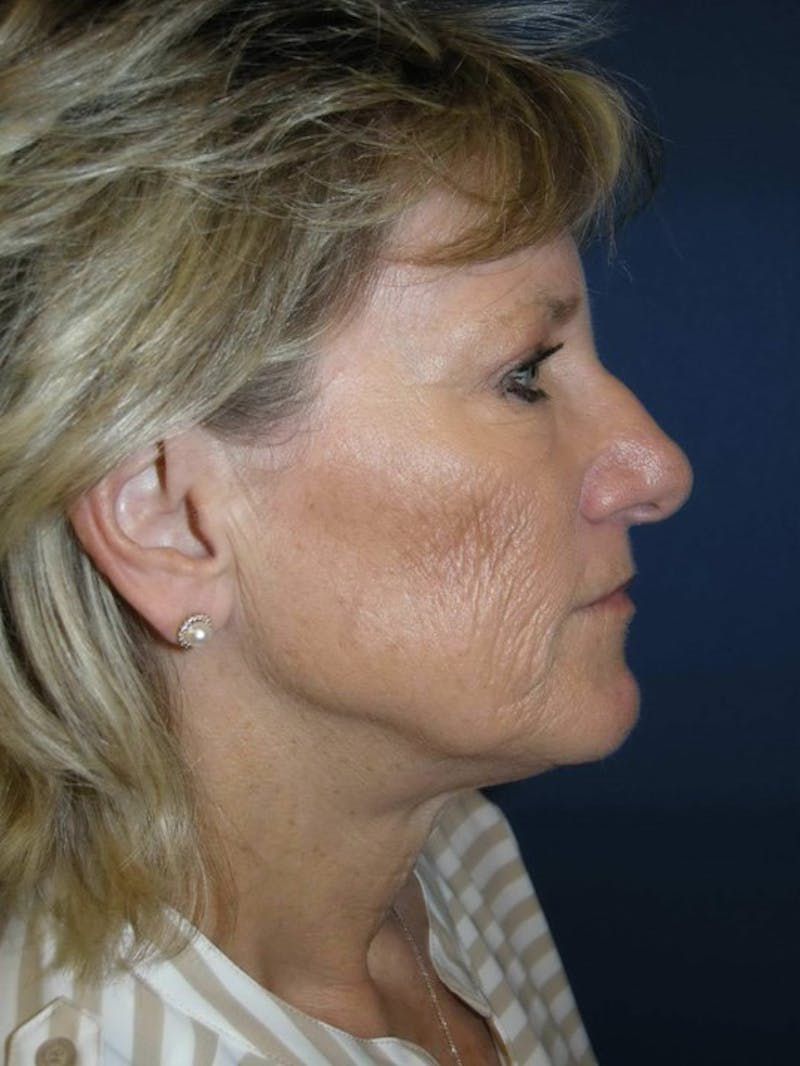 Eyelid Surgery by Dr. Haydon Before & After Gallery - Patient 55455312 - Image 5